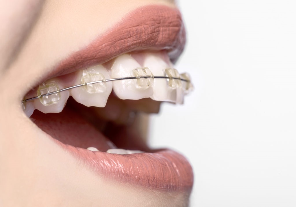 Tot ce trebuie să știi despre aparatul dentar