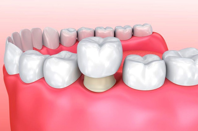 porcelain teeth