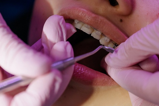 A perfect smile with dental veneers