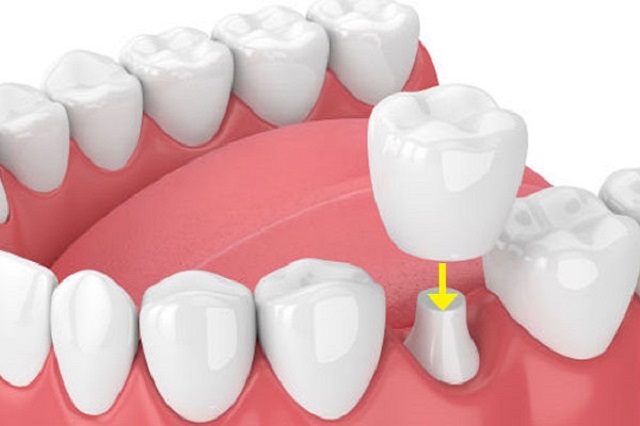 dental crown