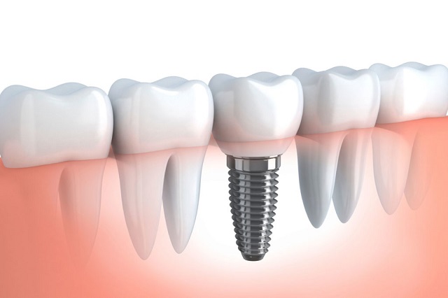 dental implant - tooth replacement